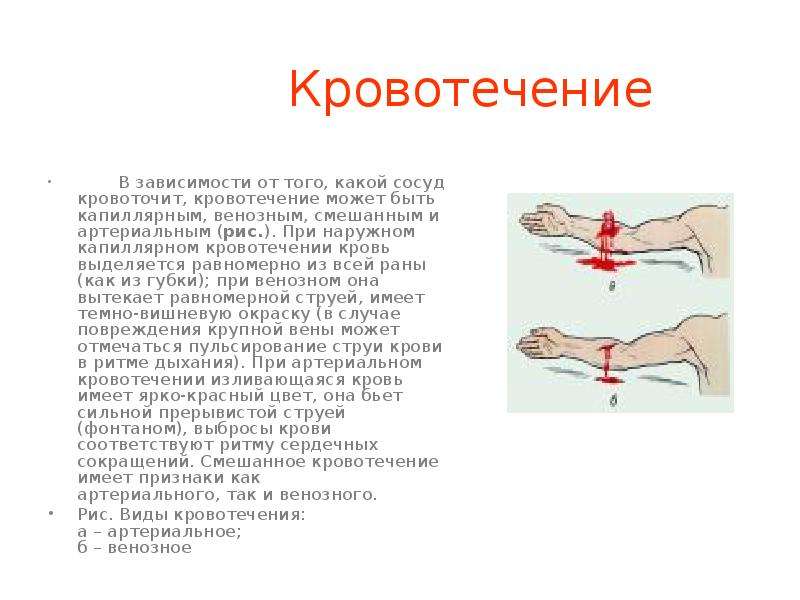 Первая помощь при капиллярном кровотечении. Смешанного кровотечения. Кровотечение может быть. Смешанное кровотечение признаки.