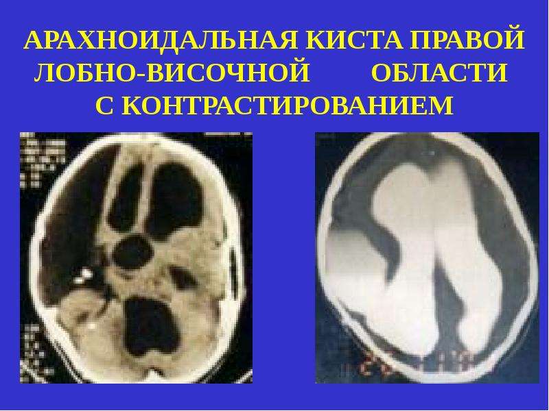Височная киста головного мозга. Арахноидальная киста сильвиевой щели. Арахноидальная киста правой лобной. Арахноидальная киста правой лобной доли. Арахноидальная киста правой височной области.