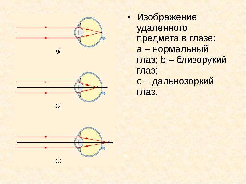 Где находится изображение предмета в близоруком глазу