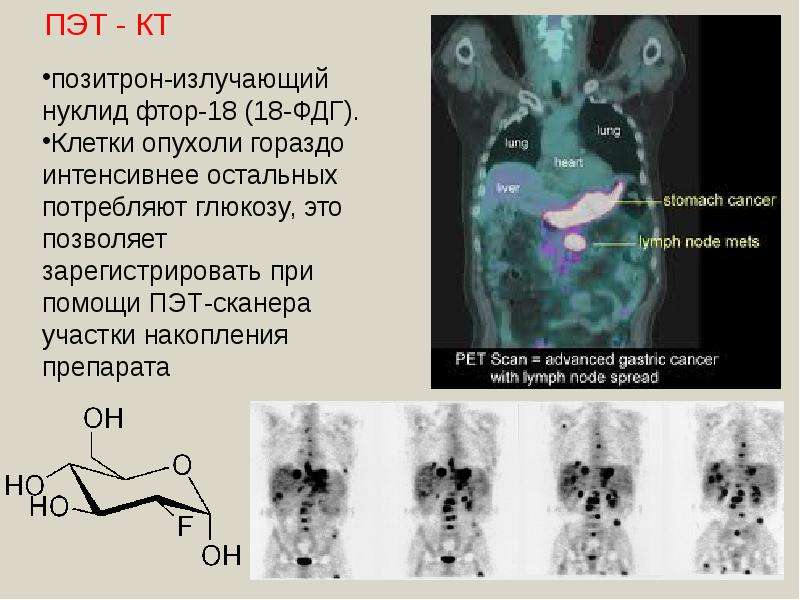 Метаболическая активность на пэт. ПЭТ-кт головного мозга с 18 ФДГ. ПЭТ кт с 18f-флюородезоксиглюкозой.