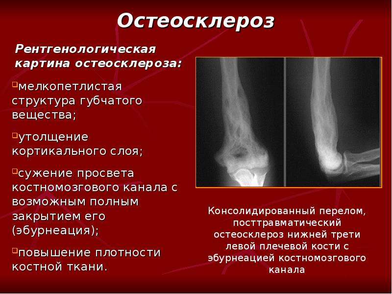 Структурные изменения костей. Остеосклероз голени рентген. Остеосклероз кости рентген. Остеосклероз бедренной рентген. Остеосклероз рентген признаки.