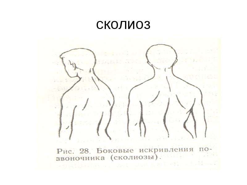 Сколиоз вид сбоку. Сколиоз буклет. Статистика сколиоза. Тест Адамса при сколиозе.