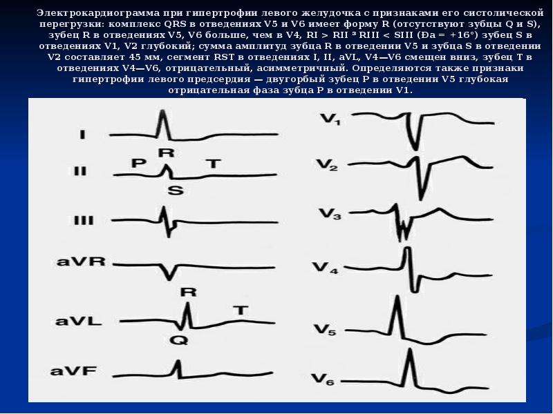Для патологического зубца q характерно. ЭКГ зубец s в v5-v6. Раздвоение зубца r в отведениях v4-v6. ЭКГ зубец р гипертрофия левого желудочка. Гипертрофия левого желудочка ЭКГ зубец r.