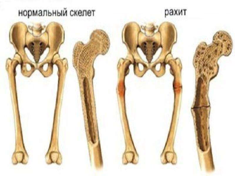 Лобные бугры при рахите фото