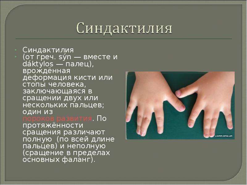 Перепонки между пальцами у мужчин. Врожденные деформации синдактилия. Синдактилия презентация.