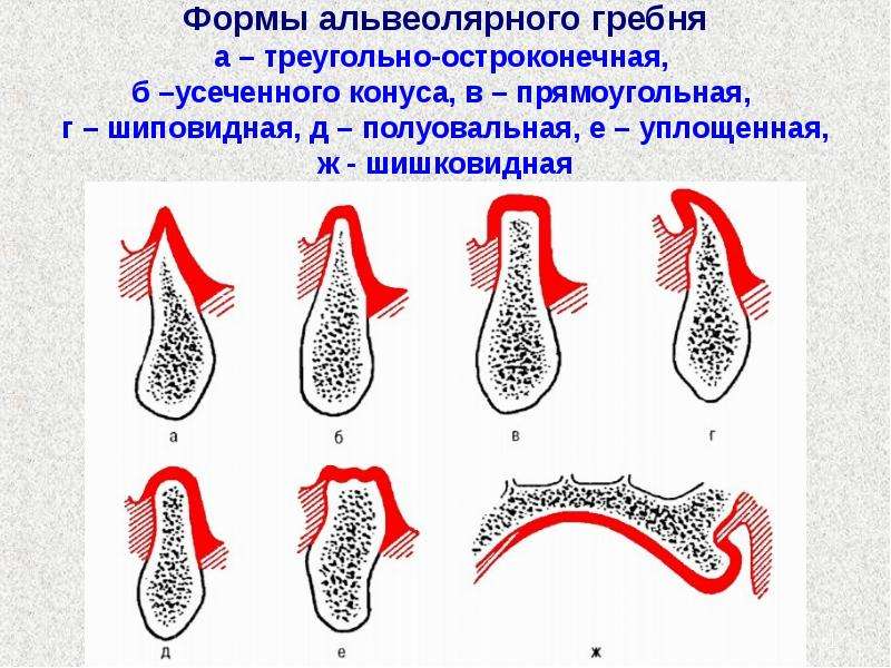 У кита альвеолярные легкие. Форма вестибулярного ската альвеолярного отростка верхней челюсти. Форма гребня альвеолярного отростка. Расщепление гребня альвеолярного отростка. Альвеолярный гребень верхней челюсти.
