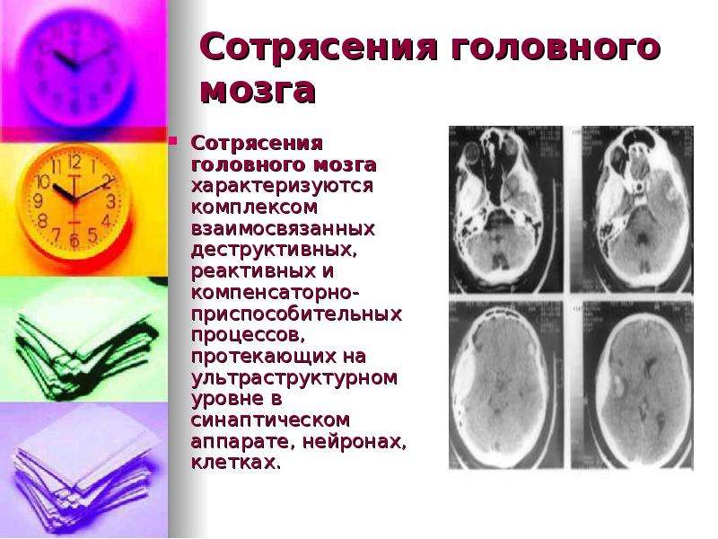 Код сотрясения головного. Сотрясение головного мозга препараты. Препараты при сотрясении мозга. Рекомендации при сотрясении мозга. Препараты от сотрясения головного мозга взрослым.