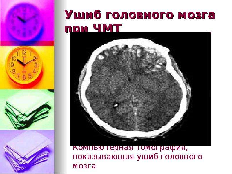 Травмы черепа и головного мозга. "Противоударная травма" головного мозга обусловлена:. Ушиб головного мозга фото. Виды гематом головного мозга.