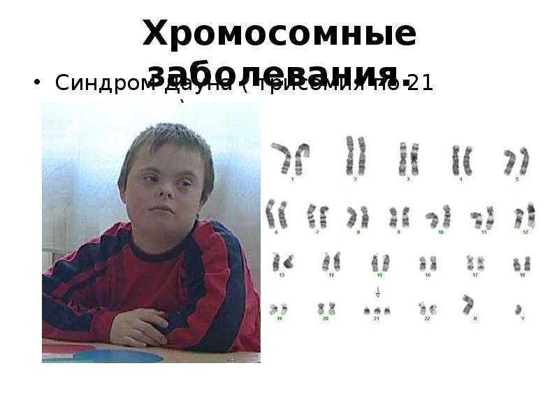 Синдром дауна лишняя хромосома. Синдром Дауна хромосомы. Синдром Дауна 21 хромосома. Трисомия по 21 хромосоме. Синдром Дауна трисомия.