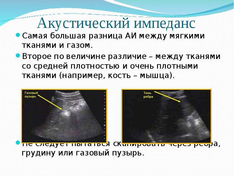 Между мягкими. Акустический импеданс. Акустический импеданс в ультразвуке. Акустическое сопротивление в УЗИ. Импеданс УЗИ.