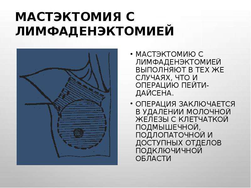 Мастэктомия молочной. Радикальная мастэктомия с аксиллярной лимфодиссекцией. Секторальная резекция молочной железы с лимфаденэктомией.