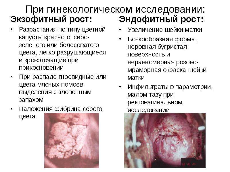 Шишка на шейке матки фото