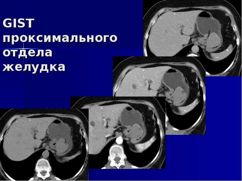 Сделать кт желудка. Гастроинтестинальная стромальная опухоль желудка на кт.