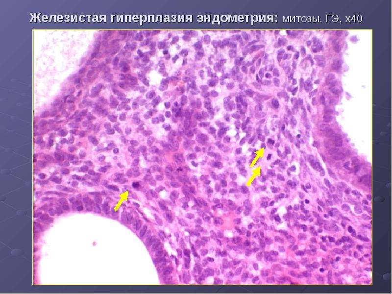 Железистая гиперплазия эндометрия после. Гиперплазия эндометрия гистероскопия. Железистая гиперплазия. Гиперплазия эндометрия митозы. Митозы в эпителии эндометрия что это.