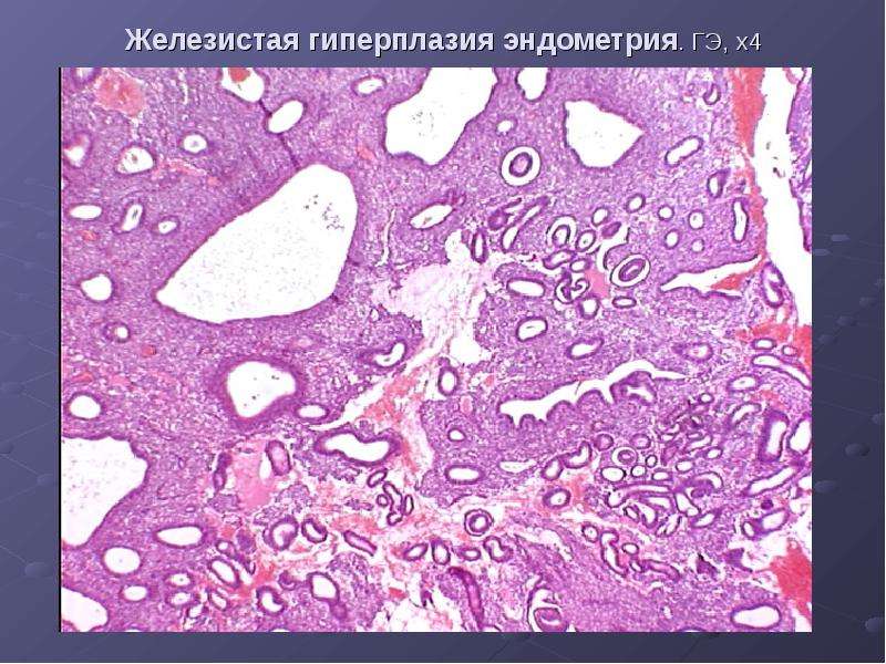 Гиперплазия желез эндометрия