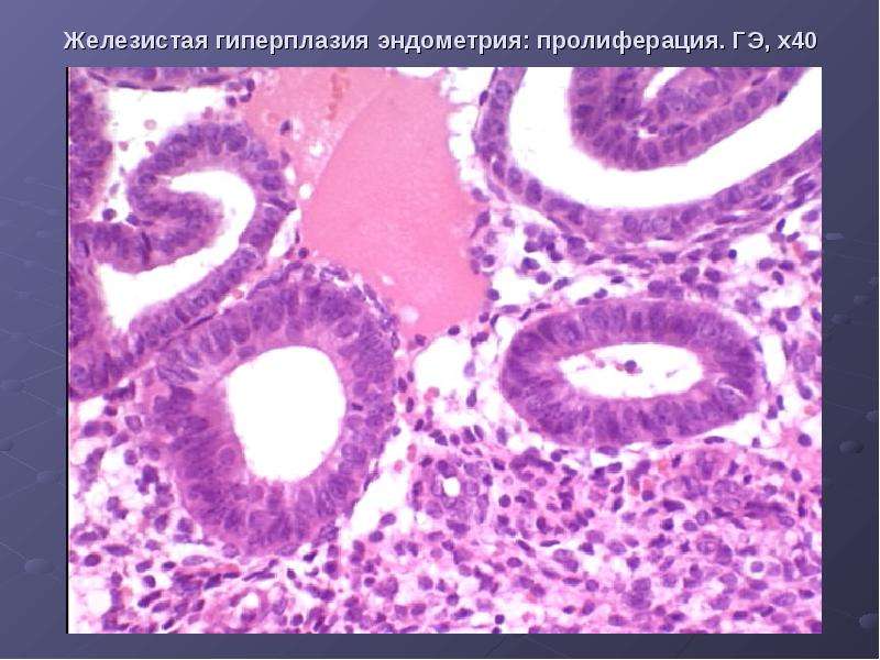 Простая атипия эндометрия. Железисто-кистозная гиперплазия гистология. Железисто-кистозная гиперплазия эндометрия микропрепарат. Гиперплазия матки гистология. Неатипическая железистая гиперплазия.