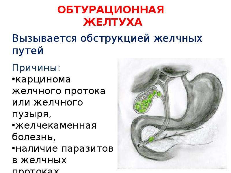 Обтурационная желтуха презентация