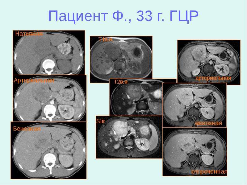 Гцр печени что это такое. Гепатоцеллюлярная карцинома печени мрт. Гепатоцеллюлярная аденома печени кт. Гепатоцеллюлярная карцинома кт.