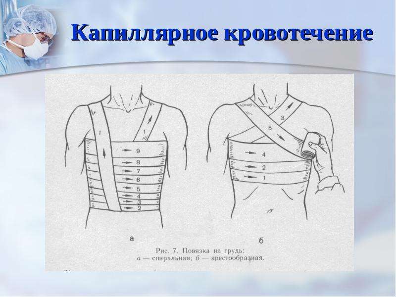 Повязка при капиллярном кровотечении. Повязка при кровотечении. Спиральная повязка на грудь. Крестообразная повязка при кровотечении.