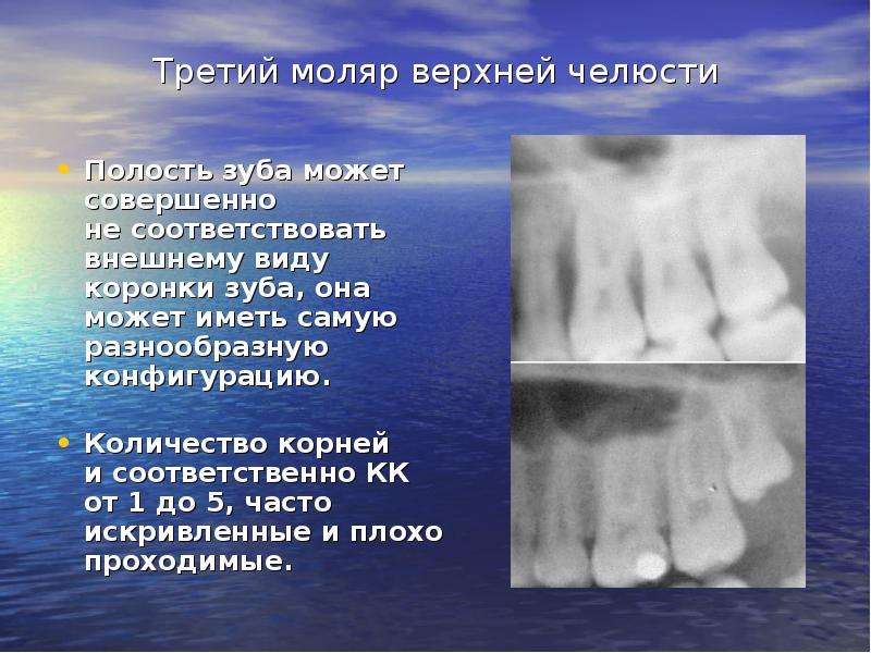 Третий моляр верхней челюсти Полость зуба может совершенно не соответствовать внешнему виду коронки