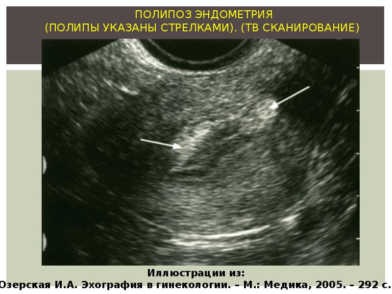 Эндометрий складки. Аденоматозные полип эндометрия УЗИ. Железисто фиброзный полип на УЗИ. Полип эндометрия бахромчатая.