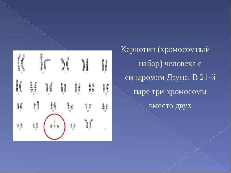 Кариотип синдрома дауна. Кариотип хромосомный набор. Синдром Дауна набор хромосом. Синдром Дауна кариотип. Кариотип человека набор хромосом.