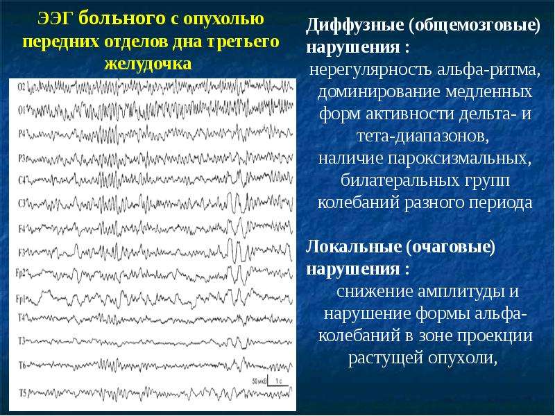 Высокая бета активность. Тета ритм ЭЭГ. Альфа ритм ЭЭГ. Энцефалограмма физиология. Нерегулярный Альфа ритм на ЭЭГ.