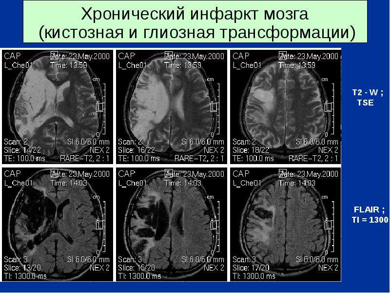 Кистозно атрофические изменения головного. Хронический инфаркт мозга. Глиозные изменения головного мозга на кт. Кистозно-глиозные изменения головного мозга что это.