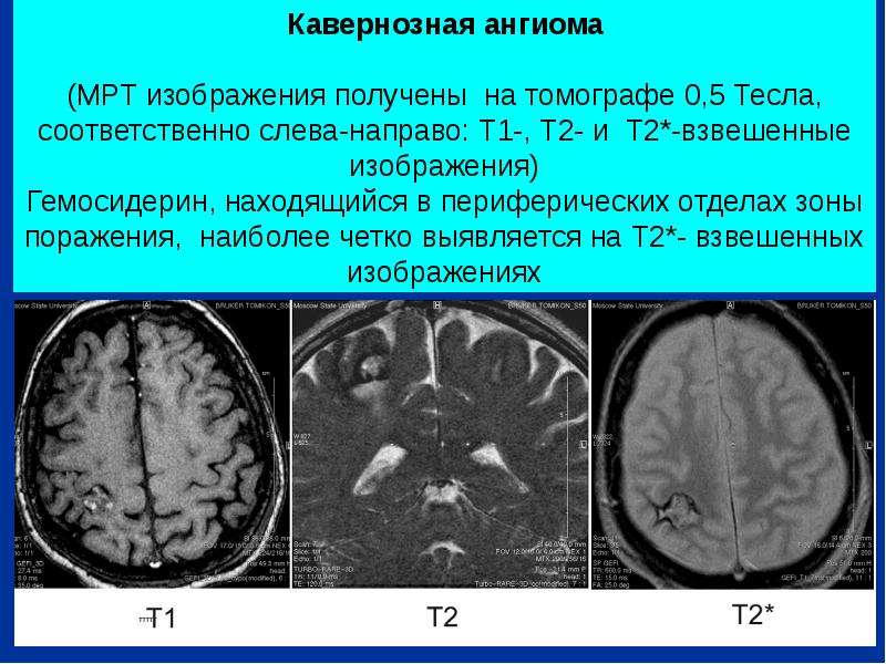Ангиома мозга лечение