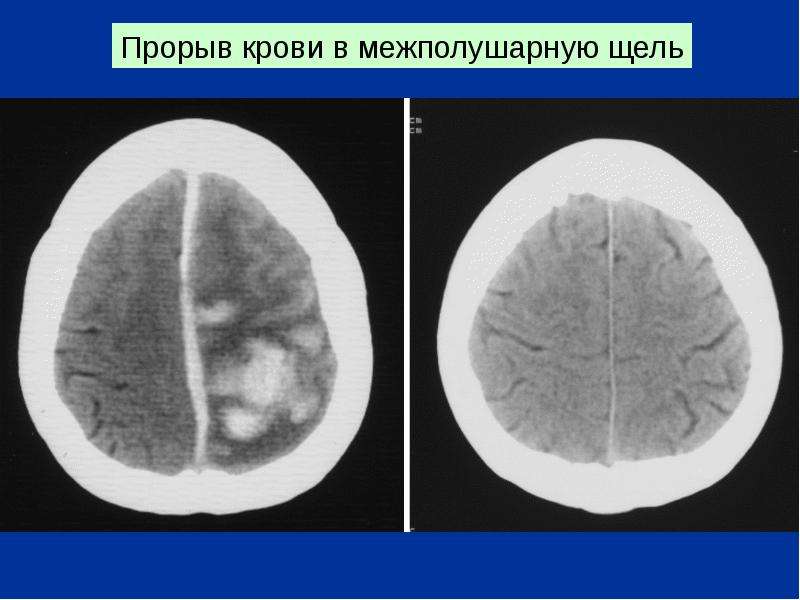 Межполушарная щель