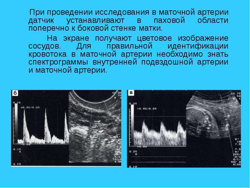 Маточная гемодинамика. Допплер сосудов матки норма. Кровоток в маточных артериях. Маточная артерия на УЗИ. УЗИ маточных артерий при беременности.