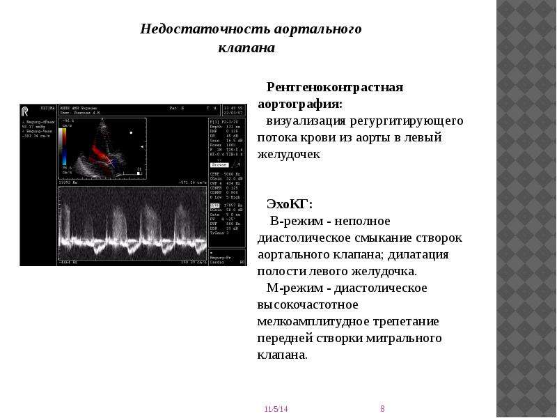 Недостаточность аортального клапана презентация