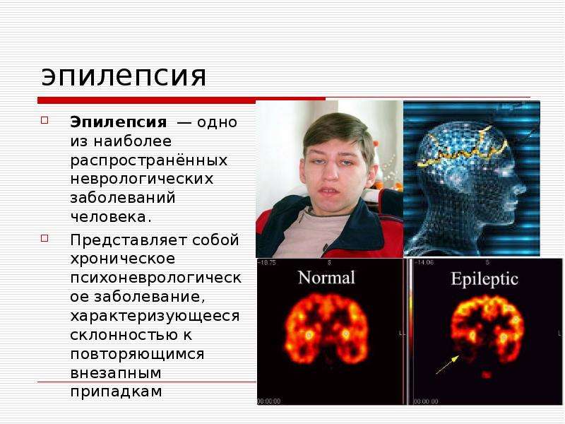 Эпилепсия презентация по неврологии