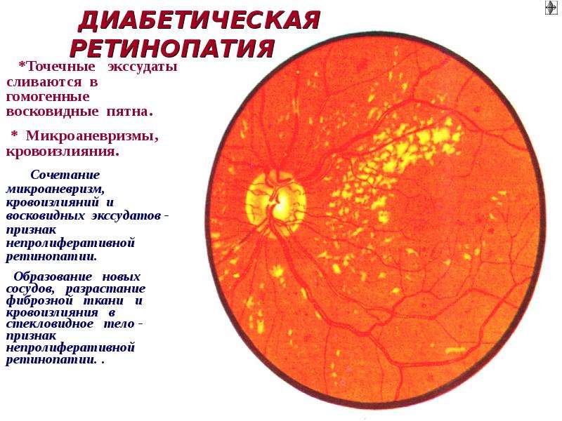 Ангиопатия сетчатки мкб 10. Ретинопатия непролиферативная стадия. Непролиферативная диабетическая ретинопатия глазное дно. Непролиферативная диабетическая ретинопатия патогенез. Пролиферативная диабетическая ретинопатия мкб.