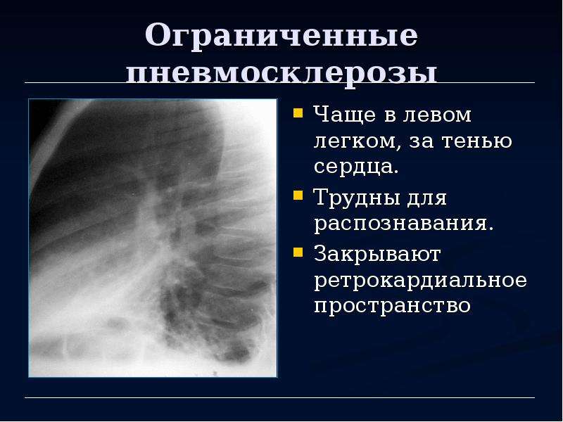 Диффузный пневмосклероз это рак. Постпневмонический пневмосклероз. Пневмосклероз рентген описание. Линейный пневмосклероз на рентгене легких.