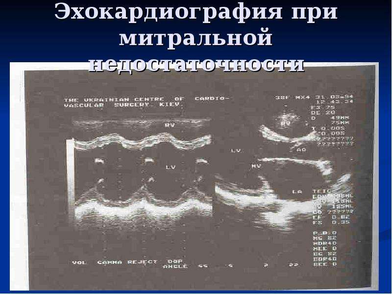 Презентация пороки сердца пропедевтика