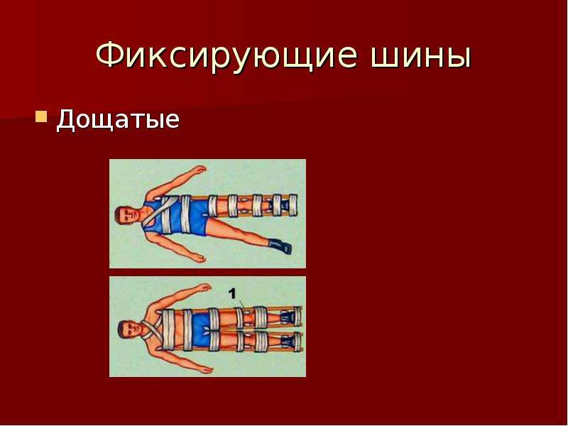 Иммобилизация при ожогах. Транспортная иммобилизация при разрыве мышц. Иммобилизацию в кровати при помощи связок. Как необходимо провести иммобилизацию позвоночника. Шина не зафиксирована что будет.