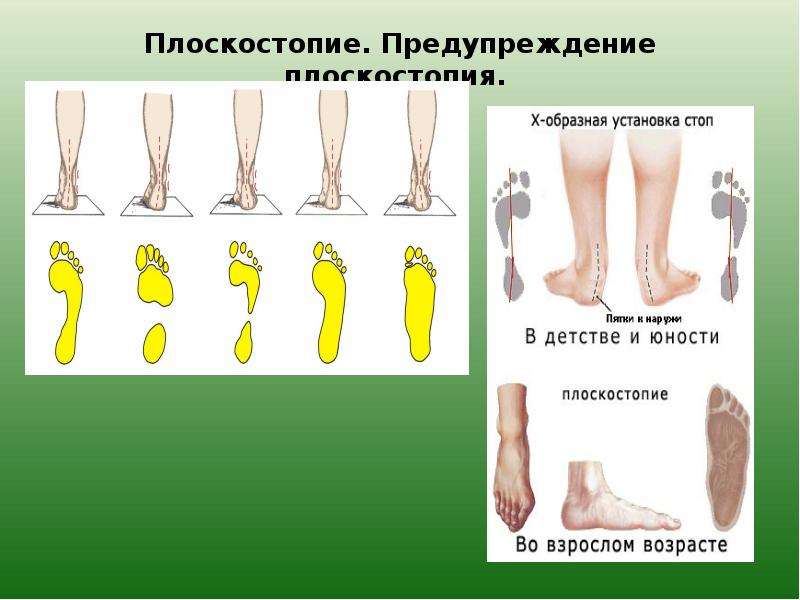 Профилактика плоскостопия. Последствия плоскостопия. Предупреждение плоскостопия. Осложнения плоскостопия. Последствия при плоскостопии.