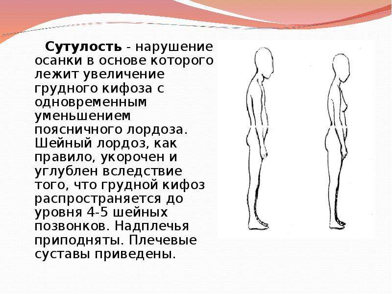 Главной причиной нарушения осанки является. Нарушение осанки сутулость. Нарушение осанки кифоз. Нарушение осанки лордоз. Типы нарушений осанки сутулость.