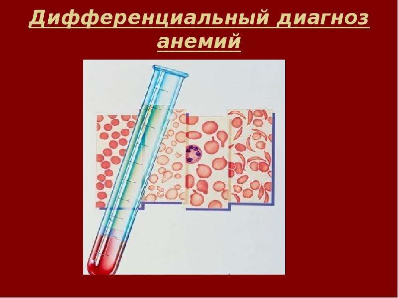 Слайды для презентаций по анемии