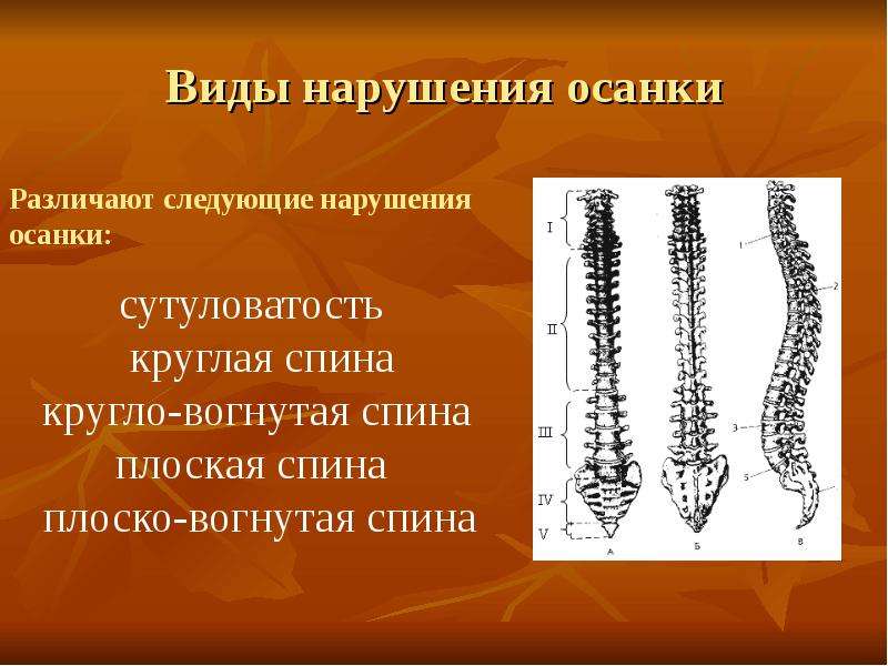 Проект по биологии сколиоз 9 класс