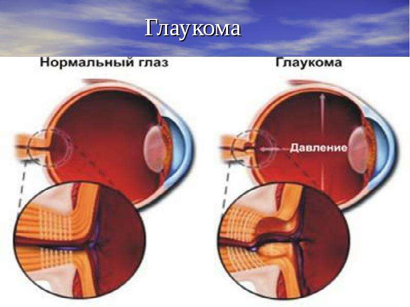 Глазное давление при катаракте. Глазное давление глаукома.