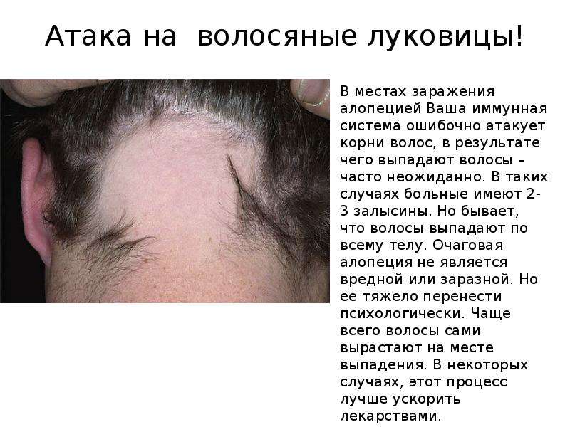 Как можно повредить волосяные луковицы на голове