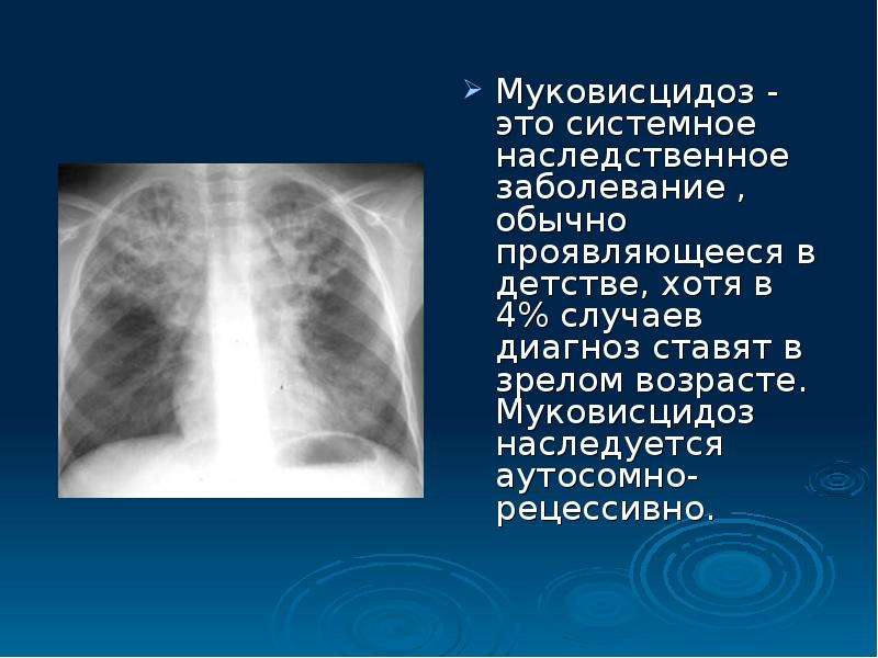 Случай диагноз. Генетическое заболевание муковисцидоз. Муковисцидоз это наследственное. Презентация по теме наследственное заболевание муковисцидоз. Системные наследственные заболевания.