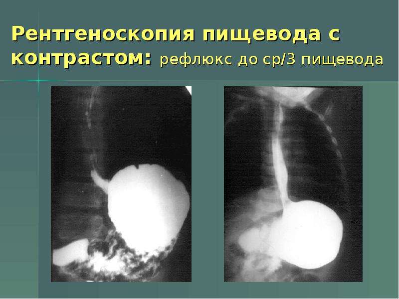 Рентгеноскопия пищевода и желудка в положении тренделенбурга что это такое фото