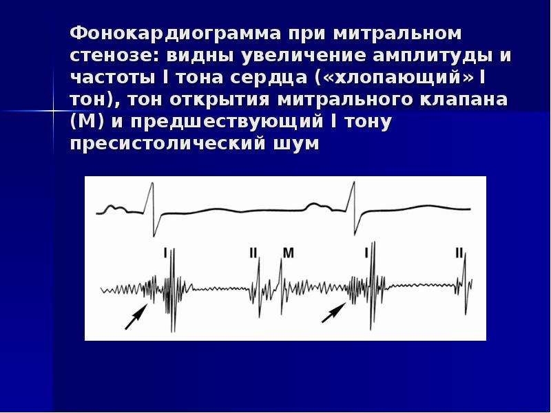 Диагноз шумы. Митральный стеноз ФКГ. Фонокардиограмма при митральном стенозе. Стеноз митрального клапана фонокардиограмма. Фонокардиография при аортальном стенозе.