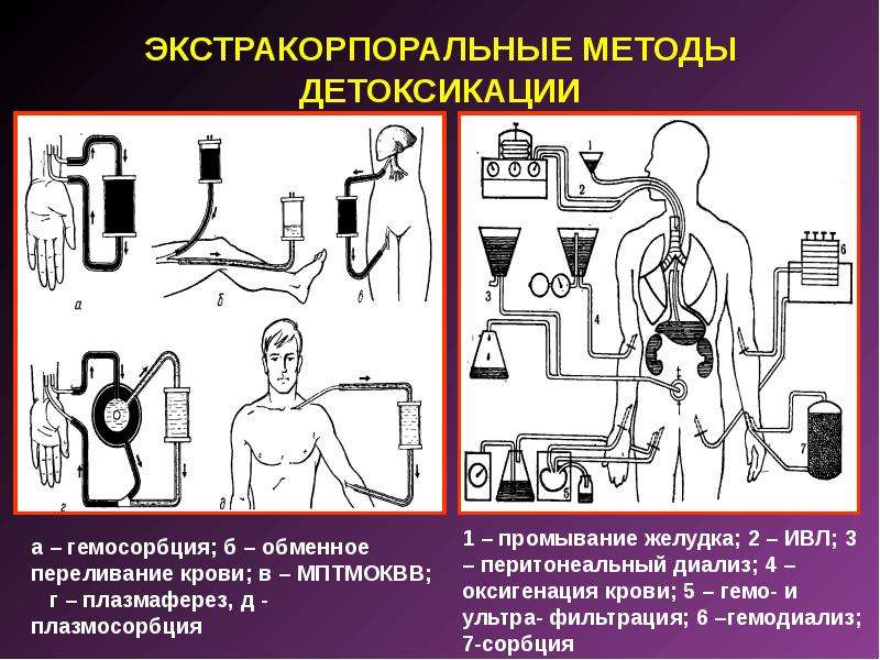 Процедура детоксикация. Экстракорпоральный метод искусственной детоксикации - это:. Интракорпоральный метод детоксикации при острых отравлениях. Экстракорпаррльные методы детоксикация. Методы экстракорпоральной детоксикации.