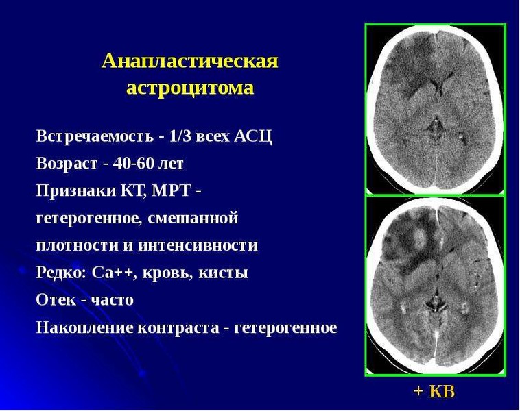Астроцитома головного мозга прогноз. Анапластическая астроцитома кт. Астроцитома гистология. Астроцитома головного мозга кт.