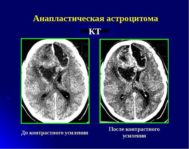 Астроцитома головного мозга прогноз. Анапластическая злокачественная астроцитома гистология. Мультифокальная астроцитома. Анапластическая астроцитома кт. Астроцитома головного мозга кт.