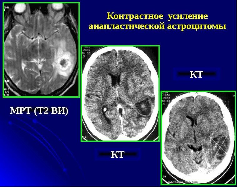 Кт без контраста. РКТ головного мозга. Опухоль мозга на мрт без контраста. Контрастное кт мозга. Опухоль головного мозга на кт без контраста.